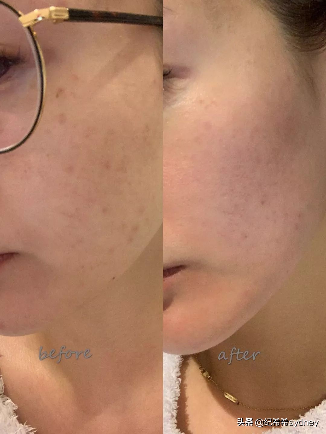 蜂巢皮秒祛斑一到七天变化图,蜂巢皮秒效果多久出来