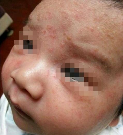 宝宝湿疹护理全过程手法,幼儿湿疹怎样正确干预