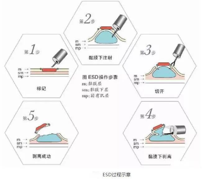 市人民医院启动消化道早癌筛查,消化道早癌筛查的社会意义