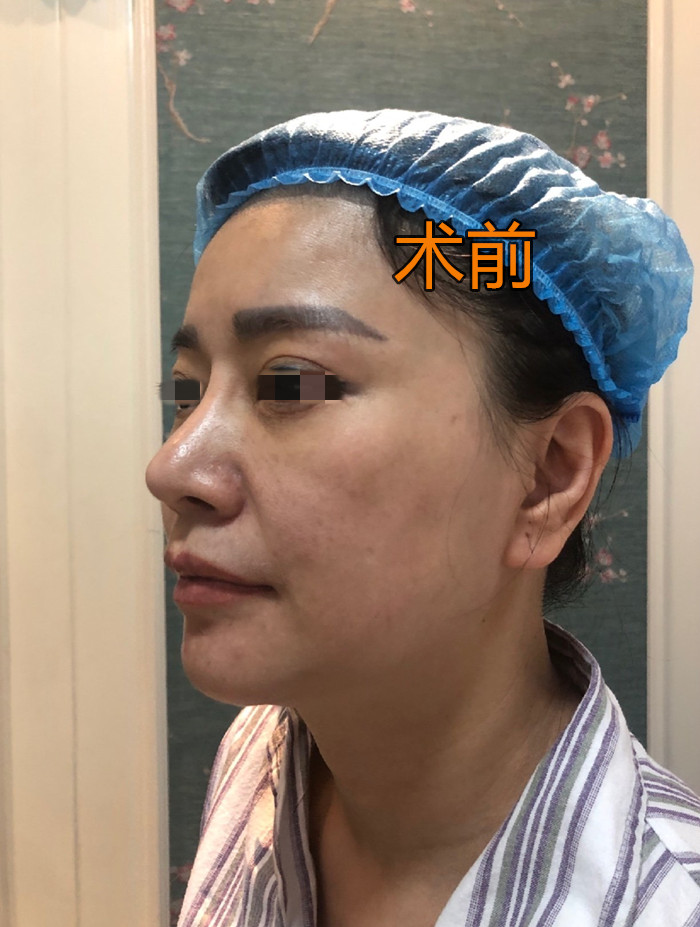 内窥镜无痕拉皮术,内窥镜脸部拉皮到底有多厉害