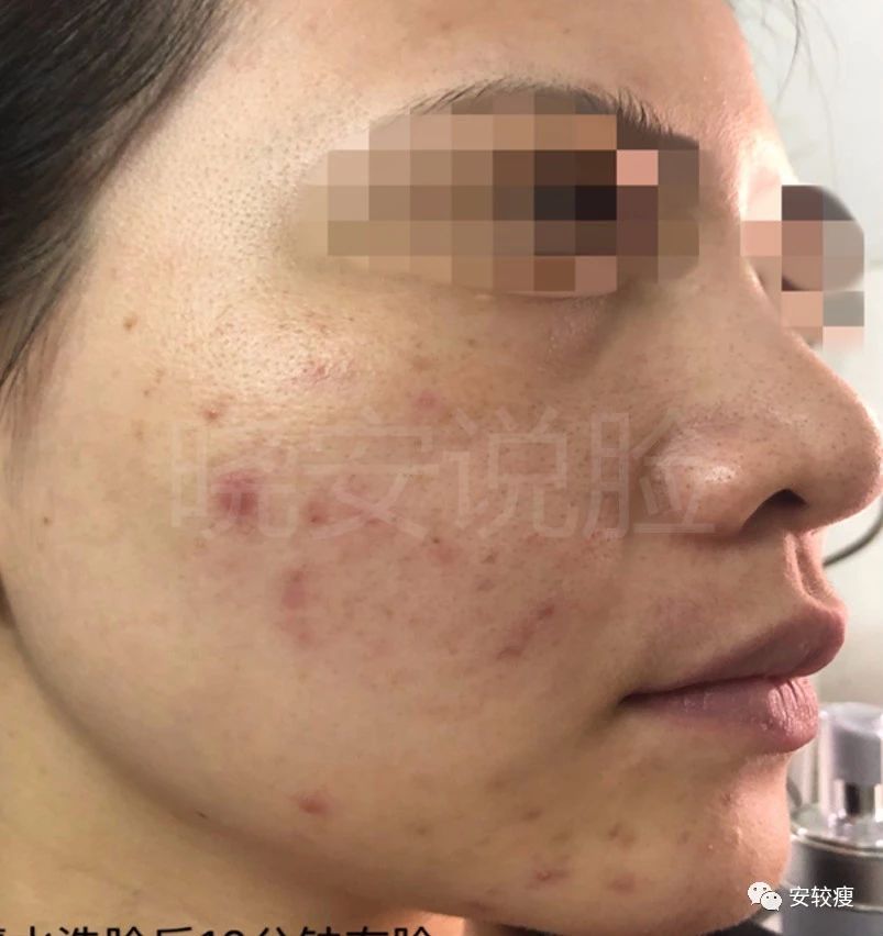 外油内干敏感痘肌怎么护肤,30岁油皮痘痘敏感肌怎么改善