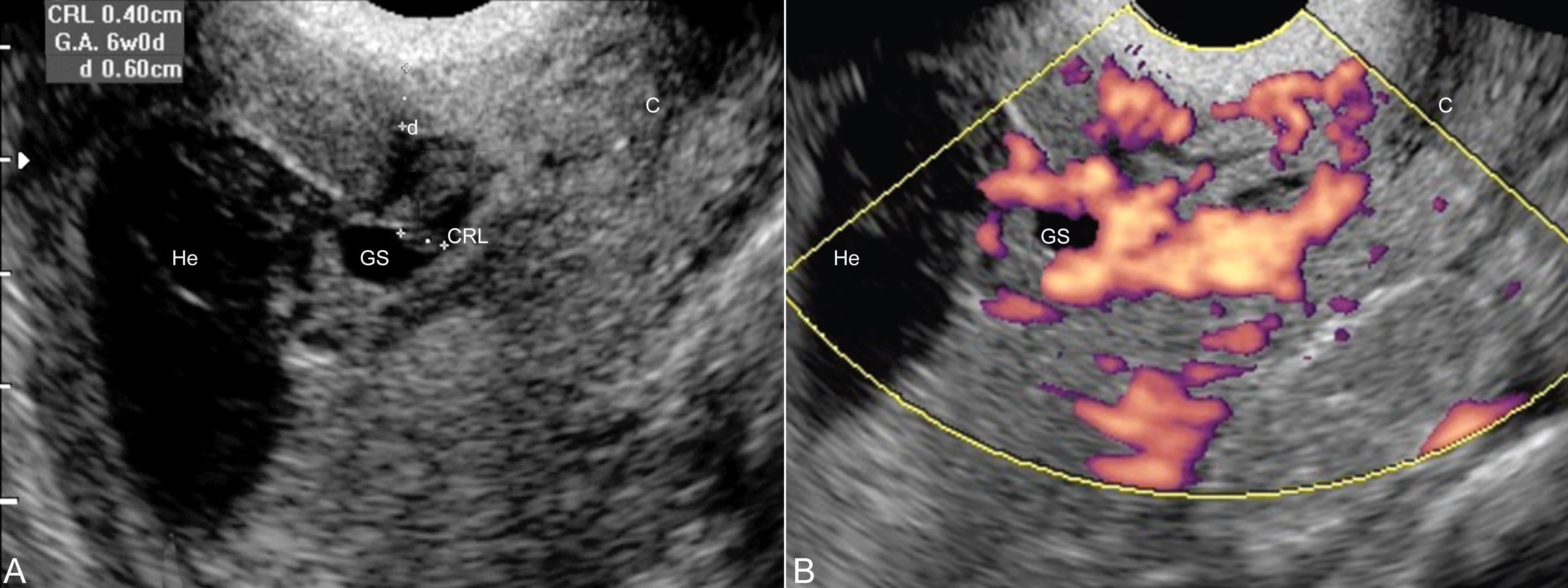 瘢痕妊娠超声经腹壁检查怎么测量,剖宫产子宫瘢痕超声检查
