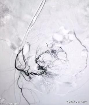 她因为子宫肌瘤贫血，差点切除子宫！还好新型疗法帮了她