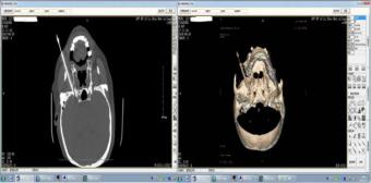 治疗带状疱疹后遗神经痛，这些方法就够了