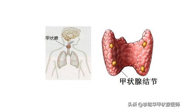 甲状腺结节钙化的严重吗能治好吗,甲状腺结节钙化有多少可能性癌变