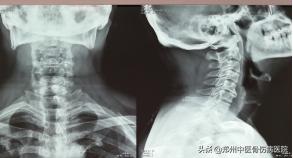 李氏砭法刮痧培训班在我院举办,铜砭虎符耳部刮痧手法视频教学