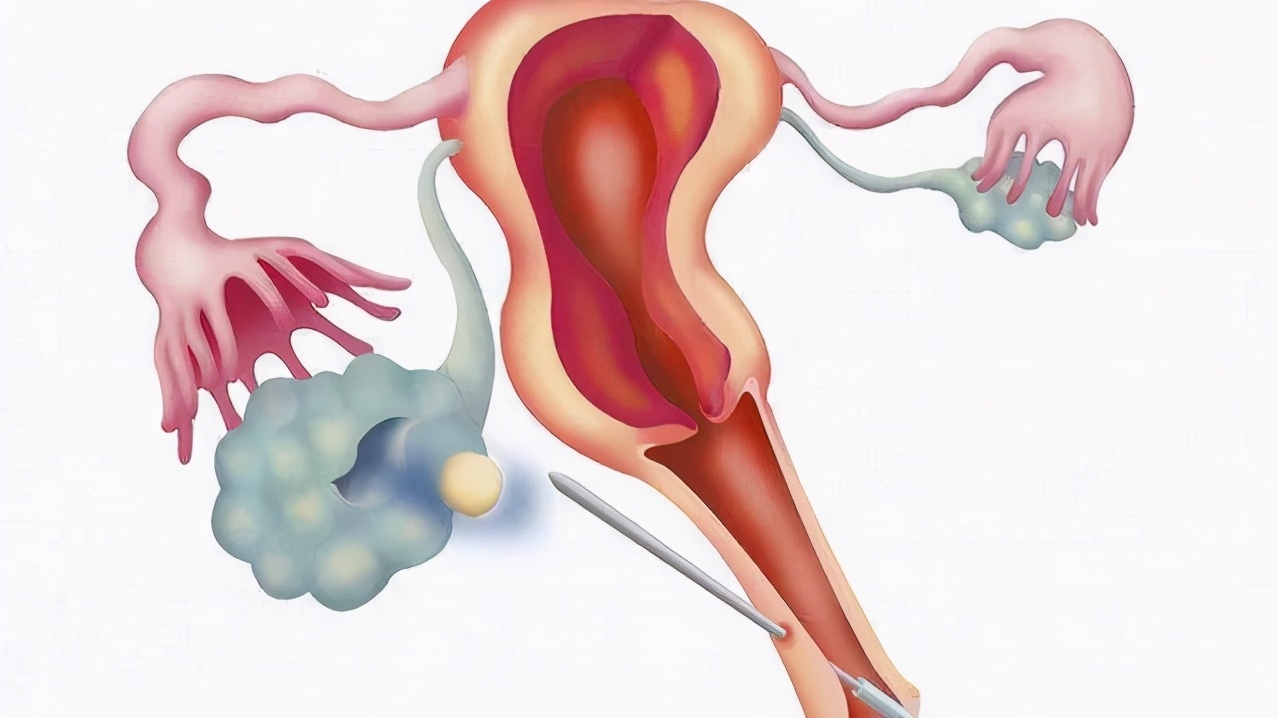 试管取完卵后腹痛怎么缓解,试管后已经着床便秘能稍微用力吗