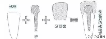 根管治疗戴冠后里面的牙还会烂吗,根管治疗戴冠后一周出现疼痛