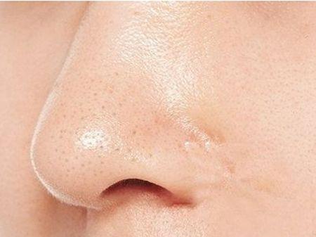 牙膏真的可以去黑头吗,黑头清理方法学生不花钱用牙膏