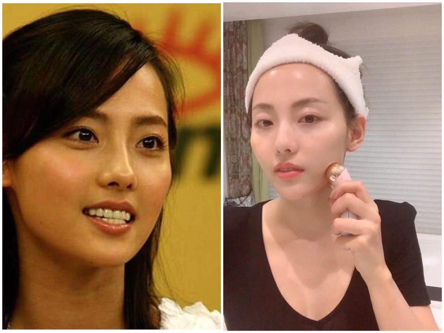 19岁姑娘打溶脂针,女子打美容针脸肿