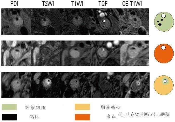 超声颈部血管斑块评估,颈动脉斑块mr成像技术