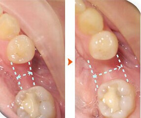 为什么有人做种植牙还需要植骨,植骨后多久可以戴义齿