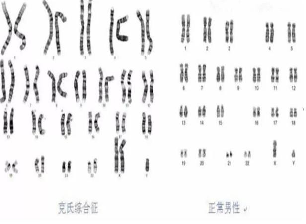 男性青春发育延迟的诊治,男性青春发育延迟的诊断与治疗