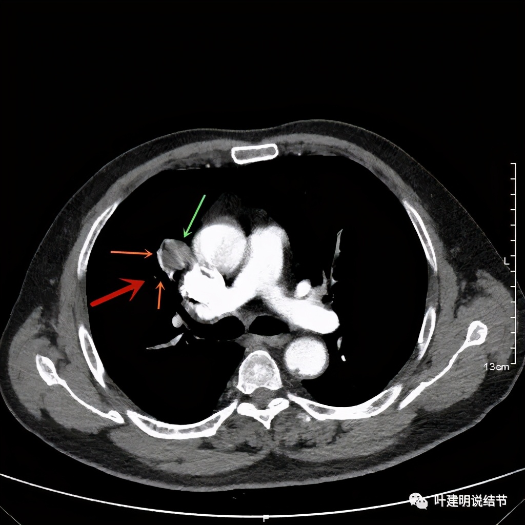 误诊报告图片,误诊案例及案例分析
