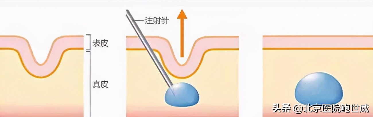 泪沟严重显老怎么办,泪沟显老的地方