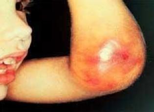 血友病基础常识题目,血友病儿童的预防性治疗