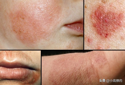 肛门湿疹痒用什么药,会阴处湿疹用什么药