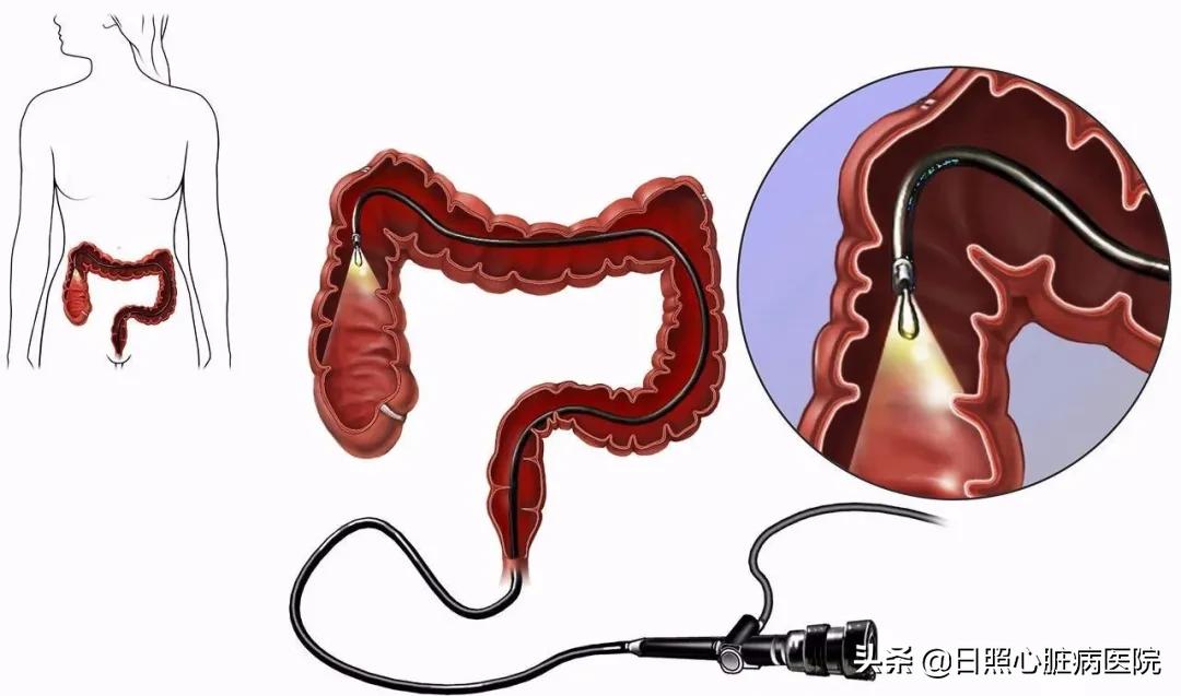 担心结肠息肉癌变,害怕肠镜检查出问题怎么办