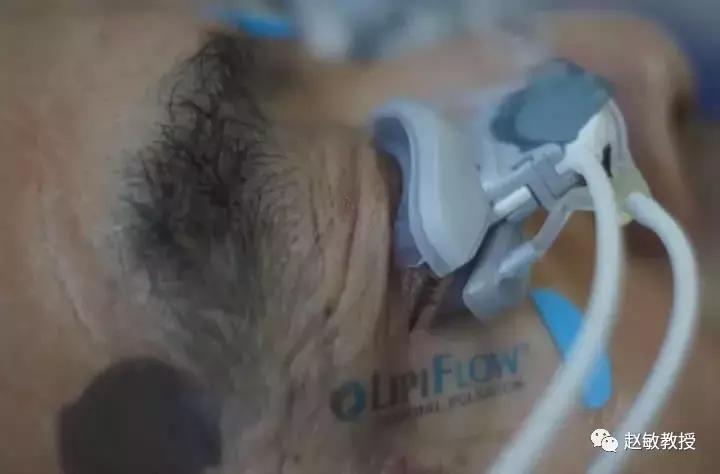 干眼症福音!眼视光眼科干眼治疗新技术