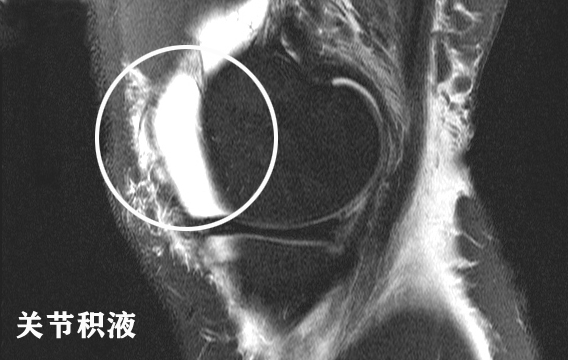 膝关节核磁共振报告单上怎么看,膝关节核磁正常报告单