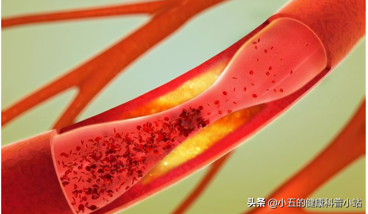 能稳定斑块的中成药,既能降压又能降脂的药