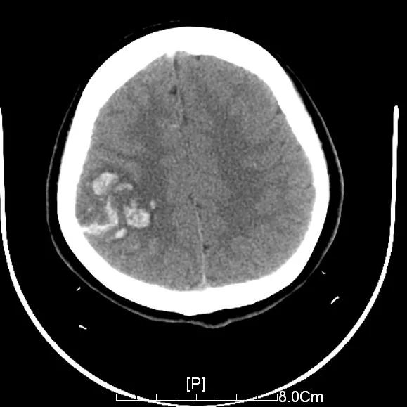 女性吃避孕药致脑梗,女子吃避孕药引发脑梗去世