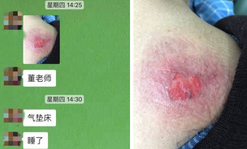 压疮液体敷料怎么用,压疮的治疗首选敷料