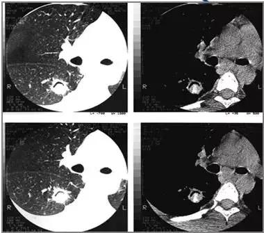 肺部ct十大征象,肺部ct正常图和异常图的区别