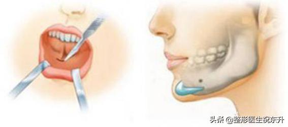 假体做下巴和玻尿酸哪个好,下巴是假体好还是玻尿酸好