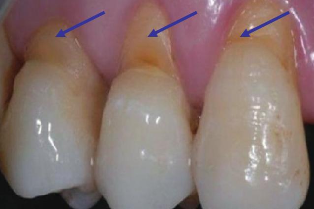 牙齿侧面有个小黑洞擦牙会酸,牙齿上有洞喝水冒凉气怎么治疗