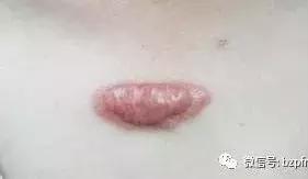 瘢痕疙瘩都有哪些治疗方法呢？