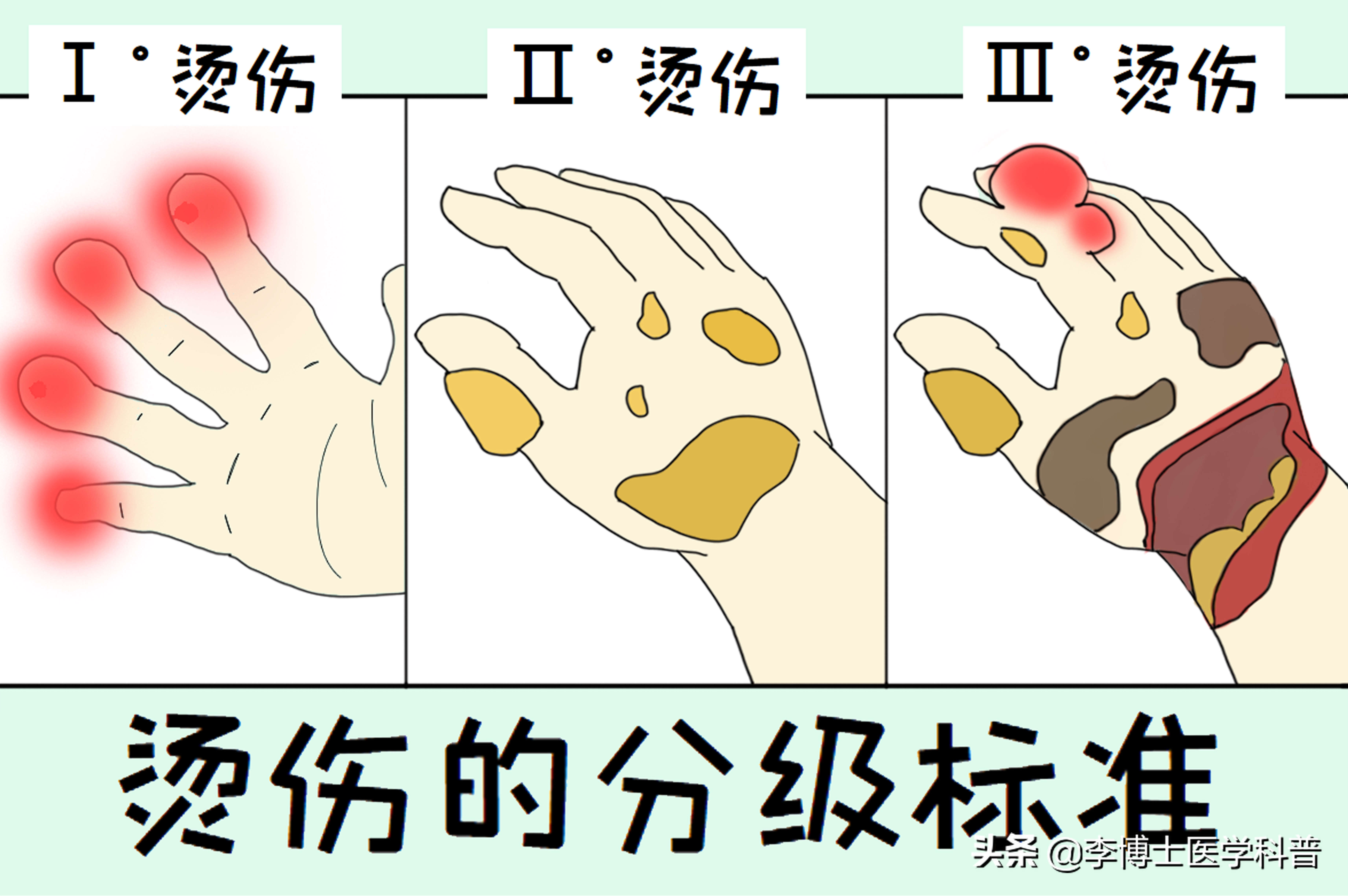 对于烧烫伤正确的处理方法,烧烫伤患者现场处理方法有