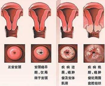 请收藏，迄今最全面的宫颈癌疫苗问答，都在这了
