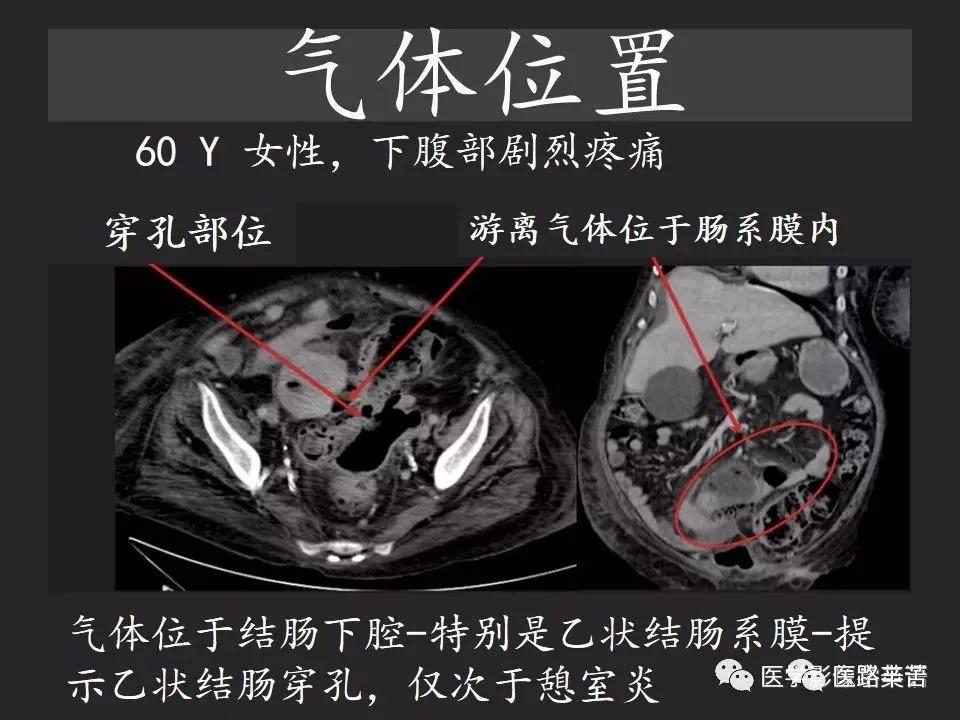 空腔脏器穿孔和胃肠道穿孔区别,腹膜后穿孔一般是哪里穿孔