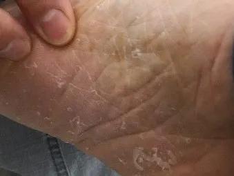 沈腾有脚气吗,沈腾治疗强迫症