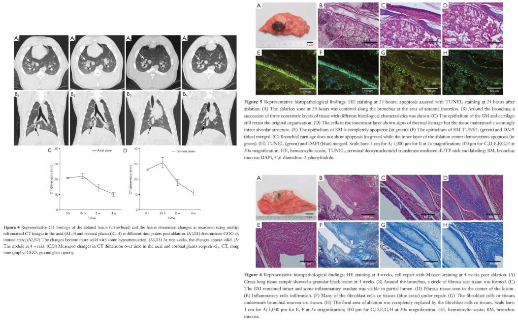 小细胞肺癌的气管镜介入治疗,导航支气管镜在肺癌诊断中的应用