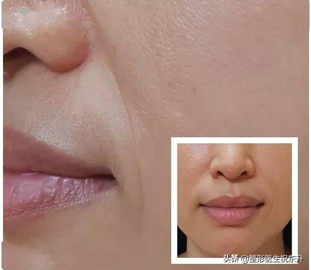 玻尿酸和肉毒素填充法令纹全过程,法令纹应该打肉毒素还是玻尿酸