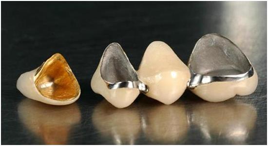 根管治疗后牙冠一般用什么材质,一般什么样才需要做牙冠