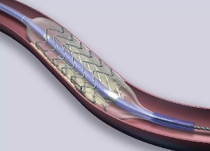 颈动脉支架的利与弊有哪些,颈动脉血管做支架能活多久