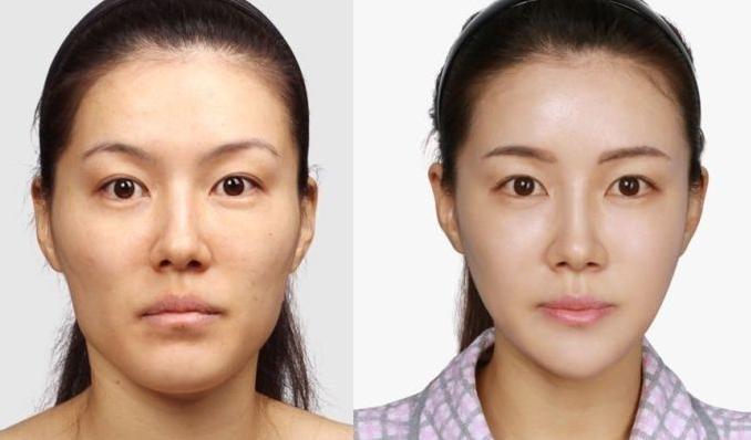 填充太阳穴改善颧骨的案例,颧骨突出要不要整