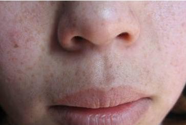 四种螨虫都是什么螨虫,皮肤上有螨虫的表现