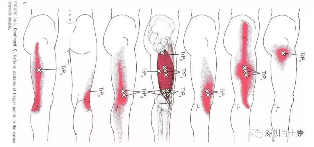 肌筋膜疼痛讲的是什么,最全肌筋膜触发点图解