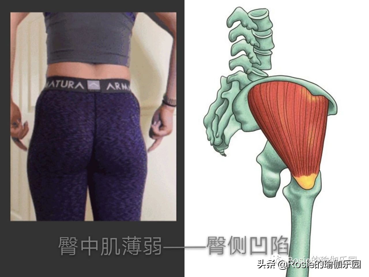 “翘臀”还有假?先自测再确认:你是真“翘臀”还是骨盆前倾?