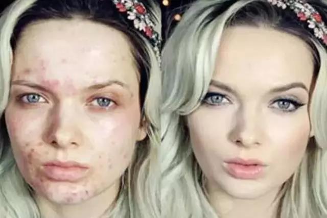 祛痘好方法更快更有效,祛痘最真实的方法