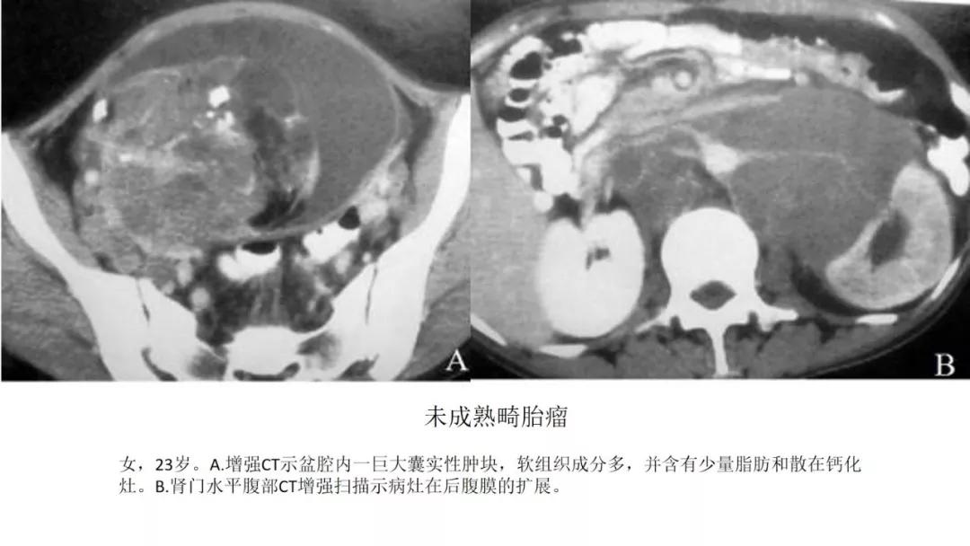 卵巢原发肿瘤的分析思路