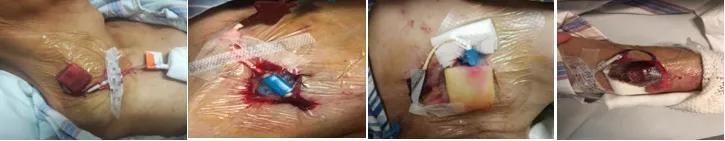 中心静脉导管穿刺点处渗液,中心静脉导管漏淋巴液