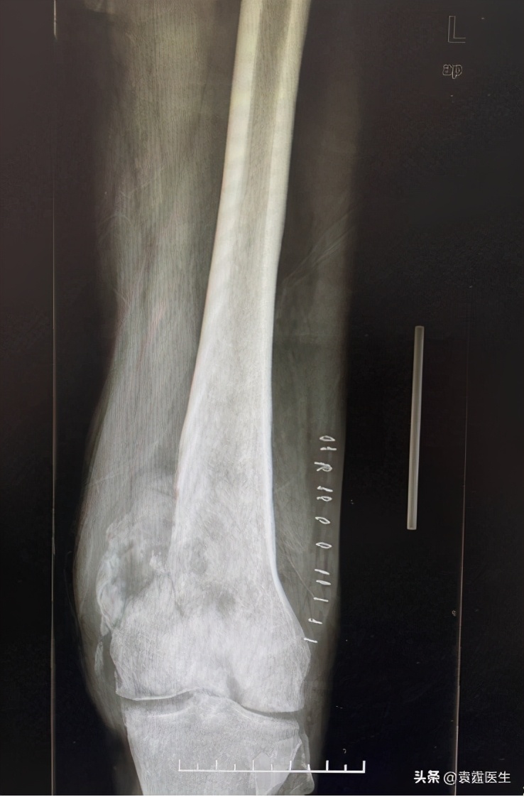 骨梗死是骨髓炎引起吗,骨梗死属于骨坏死吗