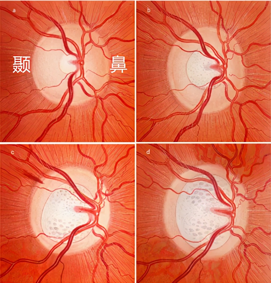 青光眼杯盘比增大机制,杯盘比大于多少怀疑青光眼