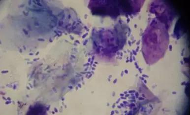 头皮屑重怎么去除头皮屑,头皮屑过多什么原因怎样去除