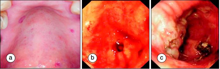 系统性硬化症/硬皮病是什么样的疾病?